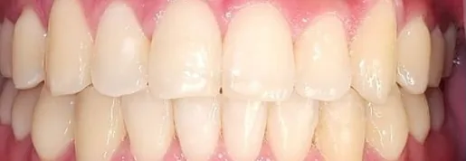 Crowded Teeth and Open Bite treated with clear aligners after orthodontic treatment at Elate Orthodontics, case 3538