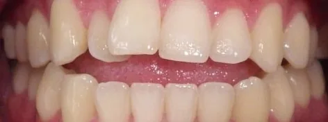 Crowded Teeth and Open Bite treated with clear aligners before orthodontic treatment at Elate Orthodontics, case 3538