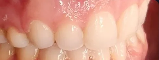 Crowded Teeth and Open Bite treated with braces after orthodontic treatment at Elate Orthodontics, case 3842