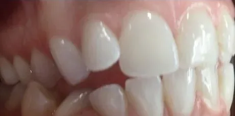 Crowded Teeth and Open Bite treated with braces before orthodontic treatment at Elate Orthodontics, case 3842