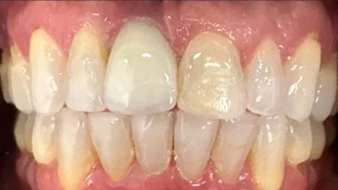 Crowded Teeth and Open Bite treated with clear aligners after orthodontic treatment at Elate Orthodontics, case 3904