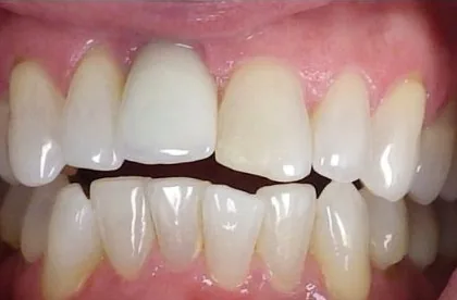 Crowded Teeth and Open Bite treated with clear aligners before orthodontic treatment at Elate Orthodontics, case 3904