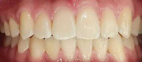Crowded Teeth and Open Bite treated with clear aligners after orthodontic treatment at Elate Orthodontics, case 3924