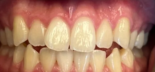 Crowded Teeth and Open Bite treated with clear aligners before orthodontic treatment at Elate Orthodontics, case 3924