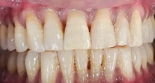 Crowded Teeth and Open Bite treated with clear aligners after orthodontic treatment at Elate Orthodontics, case 3982