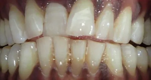 Crowded Teeth and Open Bite treated with clear aligners before orthodontic treatment at Elate Orthodontics, case 3982