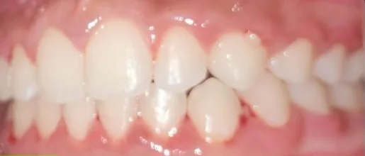 Crowded Teeth and Overbite treated with braces after orthodontic treatment at Elate Orthodontics, case 3528