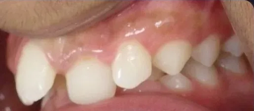 Crowded Teeth and Overbite treated with braces before orthodontic treatment at Elate Orthodontics, case 3528