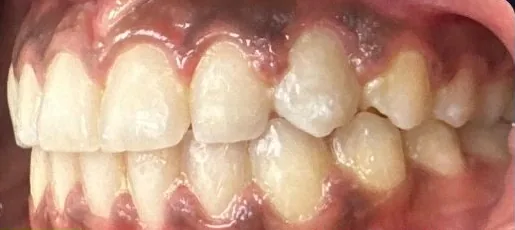 Crowded Teeth, Overbite and Impacted Teeth treated with braces after orthodontic treatment at Elate Orthodontics, case 3534