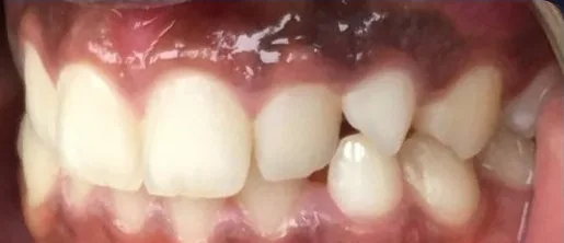 Crowded Teeth, Overbite and Impacted Teeth treated with braces before orthodontic treatment at Elate Orthodontics, case 3534