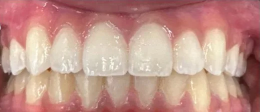 Crowded Teeth and Overbite treated with braces after orthodontic treatment at Elate Orthodontics, case 3562