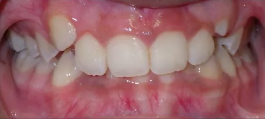 Crowded Teeth and Overbite treated with braces before orthodontic treatment at Elate Orthodontics, case 3562