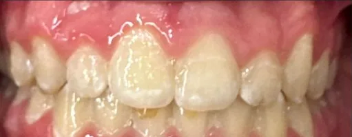 Crowded Teeth and Overbite treated with clear aligners after orthodontic treatment at Elate Orthodontics, case 3590