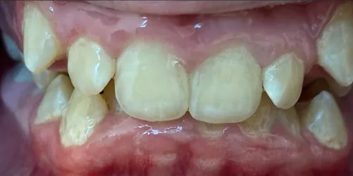 Crowded Teeth and Overbite treated with clear aligners before orthodontic treatment at Elate Orthodontics, case 3590