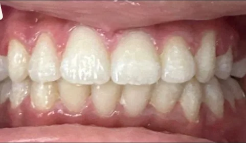 Crowded Teeth and Overbite treated with braces after orthodontic treatment at Elate Orthodontics, case 3602