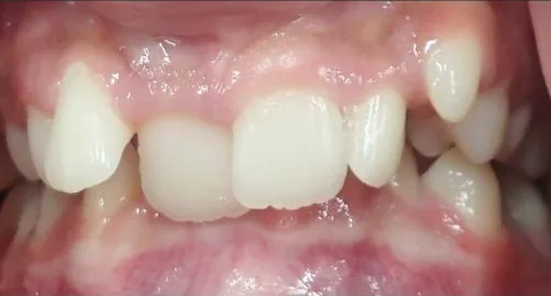Crowded Teeth and Overbite treated with braces before orthodontic treatment at Elate Orthodontics, case 3602