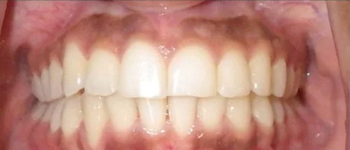 Crowded Teeth and Overbite treated with clear aligners after orthodontic treatment at Elate Orthodontics, case 3610