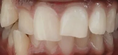 Crowded Teeth and Overbite treated with clear aligners before orthodontic treatment at Elate Orthodontics, case 3610