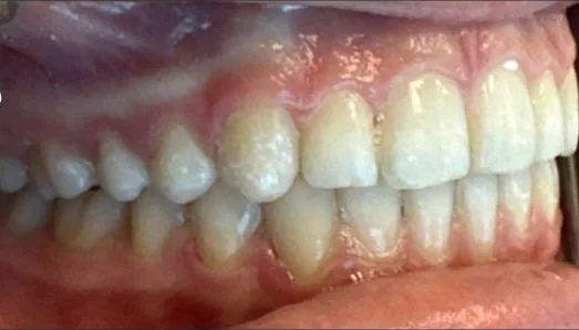Crowded Teeth and Overbite treated with clear aligners after orthodontic treatment at Elate Orthodontics, case 3632