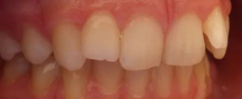 Crowded Teeth and Overbite treated with clear aligners before orthodontic treatment at Elate Orthodontics, case 3632