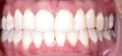 Crowded Teeth and Overbite treated with clear aligners after orthodontic treatment at Elate Orthodontics, case 3640
