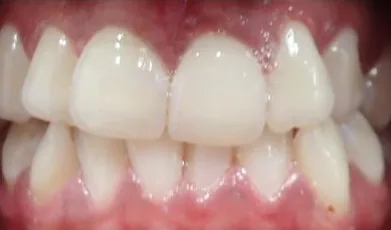 Crowded Teeth and Overbite treated with clear aligners before orthodontic treatment at Elate Orthodontics, case 3640