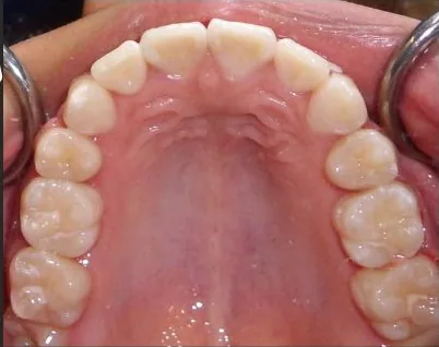 Crowded Teeth and Overbite treated with braces after orthodontic treatment at Elate Orthodontics, case 3648
