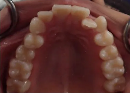 Crowded Teeth and Overbite treated with braces before orthodontic treatment at Elate Orthodontics, case 3648