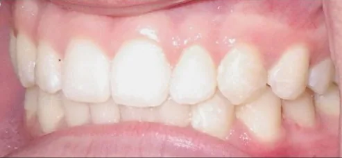 Crowded Teeth, Overbite and Overjet treated with clear aligners after orthodontic treatment at Elate Orthodontics, case 3662