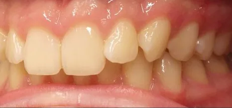 Crowded Teeth, Overbite and Overjet treated with clear aligners before orthodontic treatment at Elate Orthodontics, case 3662