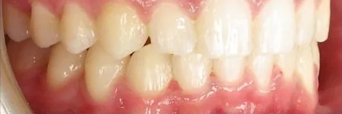 Crowded Teeth and Overbite treated with braces after orthodontic treatment at Elate Orthodontics, case 3666