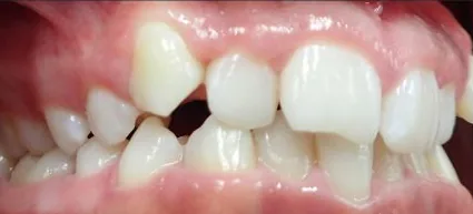 Crowded Teeth and Overbite treated with braces before orthodontic treatment at Elate Orthodontics, case 3666