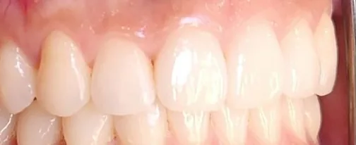Crowded Teeth and Overbite treated with braces after orthodontic treatment at Elate Orthodontics, case 3670