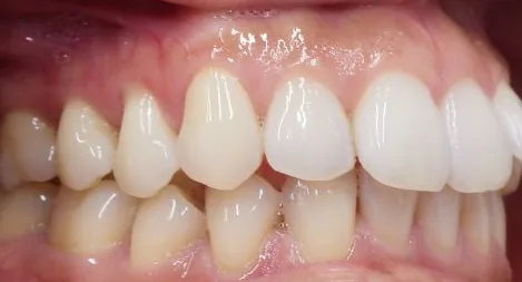 Crowded Teeth and Overbite treated with braces before orthodontic treatment at Elate Orthodontics, case 3670