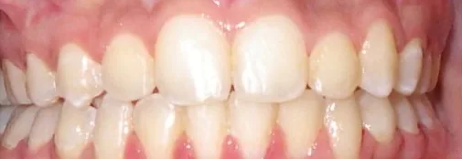 Crowded Teeth, Overbite and Overjet treated with braces after orthodontic treatment at Elate Orthodontics, case 3674