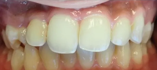 Crowded Teeth, Overbite and Overjet treated with braces before orthodontic treatment at Elate Orthodontics, case 3674