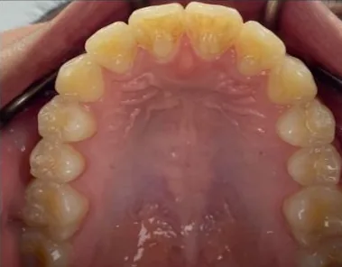 Crowded Teeth and Overbite treated with braces after orthodontic treatment at Elate Orthodontics, case 3686