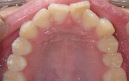Crowded Teeth and Overbite treated with braces before orthodontic treatment at Elate Orthodontics, case 3686