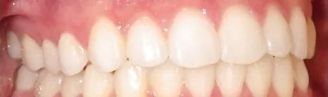 Crowded Teeth and Overbite treated with clear aligners after orthodontic treatment at Elate Orthodontics, case 3710