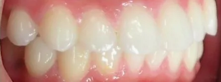 Crowded Teeth and Overbite treated with clear aligners before orthodontic treatment at Elate Orthodontics, case 3710