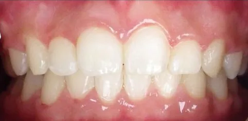 Crowded Teeth and Overbite treated with braces after orthodontic treatment at Elate Orthodontics, case 3724