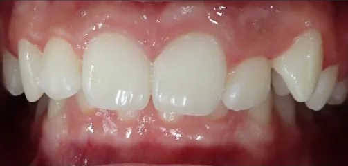 Crowded Teeth and Overbite treated with braces before orthodontic treatment at Elate Orthodontics, case 3724
