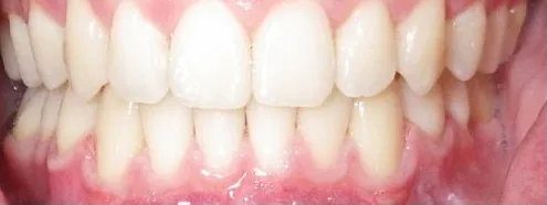 Crowded Teeth and Overbite treated with clear aligners after orthodontic treatment at Elate Orthodontics, case 3728