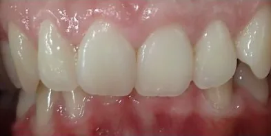 Crowded Teeth and Overbite treated with clear aligners before orthodontic treatment at Elate Orthodontics, case 3728