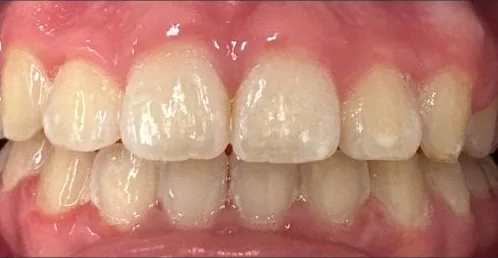 Crowded Teeth and Overbite treated with braces after orthodontic treatment at Elate Orthodontics, case 3736