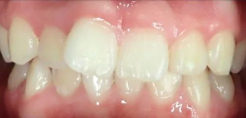 Crowded Teeth and Overbite treated with braces before orthodontic treatment at Elate Orthodontics, case 3736