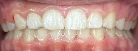 Crowded Teeth and Overbite treated with braces after orthodontic treatment at Elate Orthodontics, case 3744