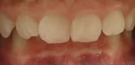 Crowded Teeth and Overbite treated with braces before orthodontic treatment at Elate Orthodontics, case 3744