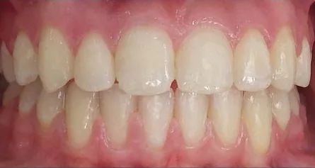 Crowded Teeth and Overbite treated with braces after orthodontic treatment at Elate Orthodontics, case 3752