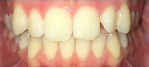 Crowded Teeth and Overbite treated with braces before orthodontic treatment at Elate Orthodontics, case 3752